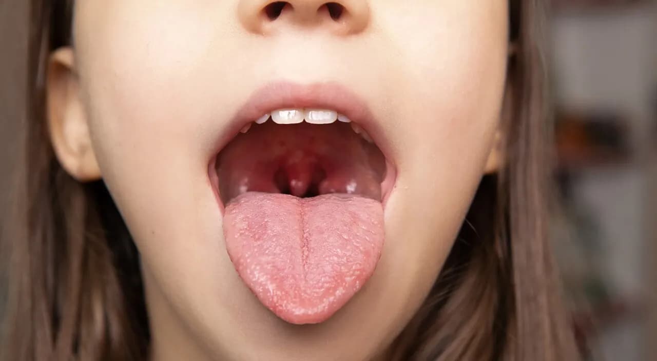 Angina ropna u dziecka ile trwa i jak skutecznie leczyć objawy
