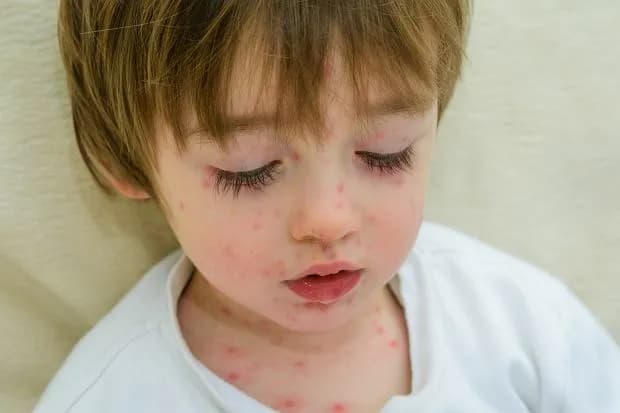 Ile trwa ospa wietrzna u dziecka? Zaskakujące fakty o chorobie